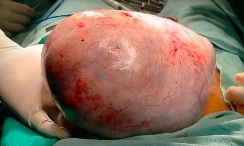 Myomectomy of a big fibroid